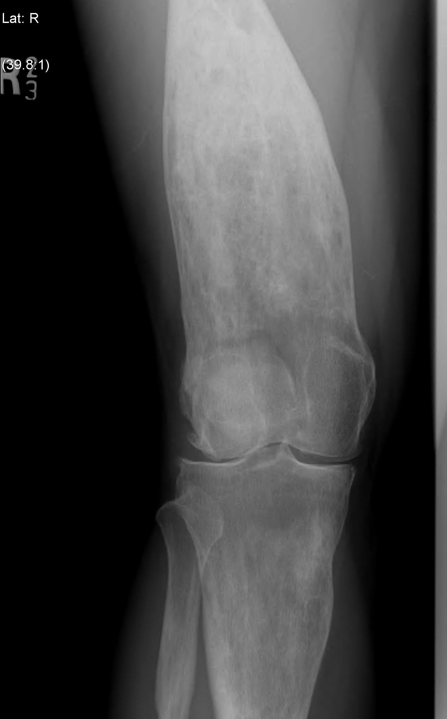 Pagets Disease Tibia Femur